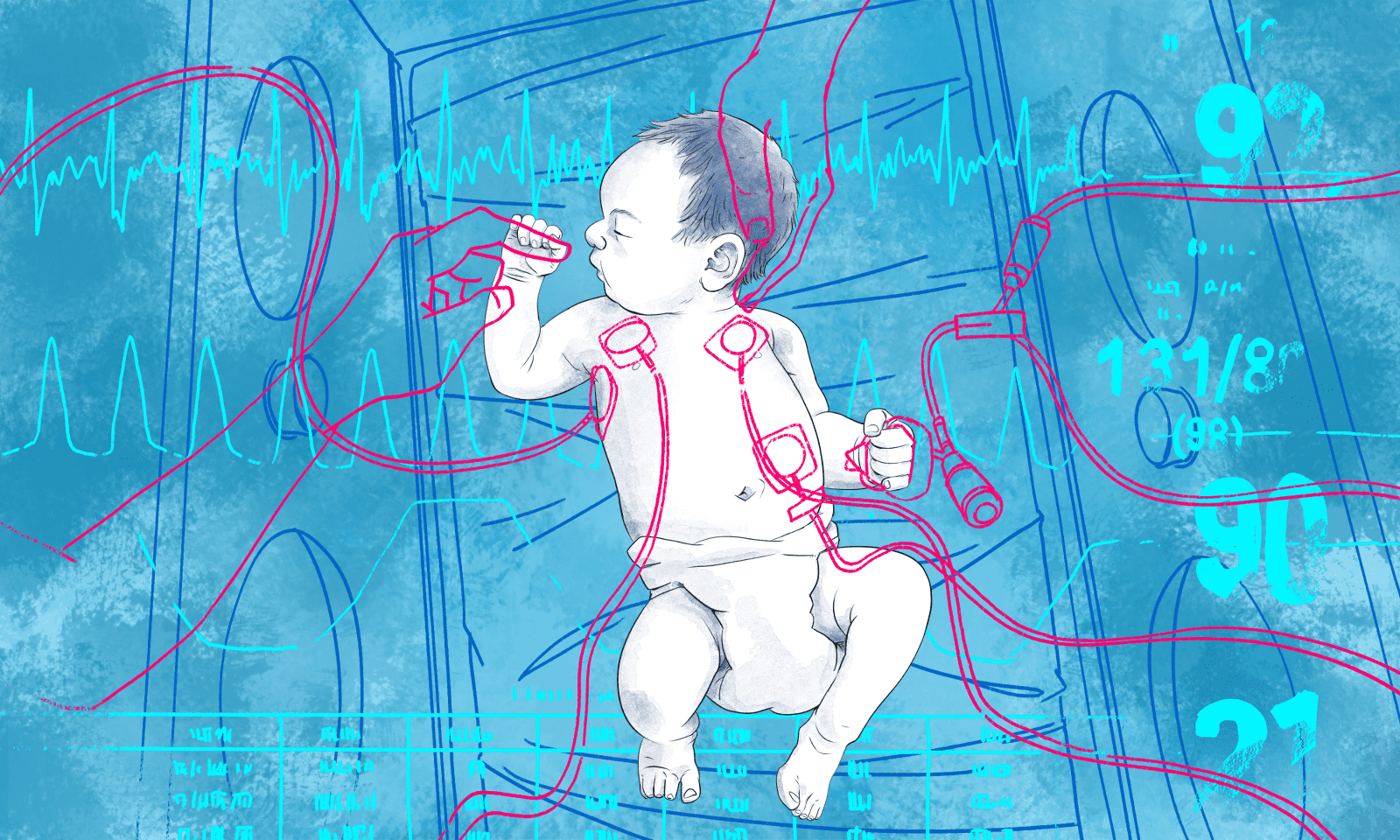 Illustration of a newborn baby patient with medical sensors and tubes on his body.