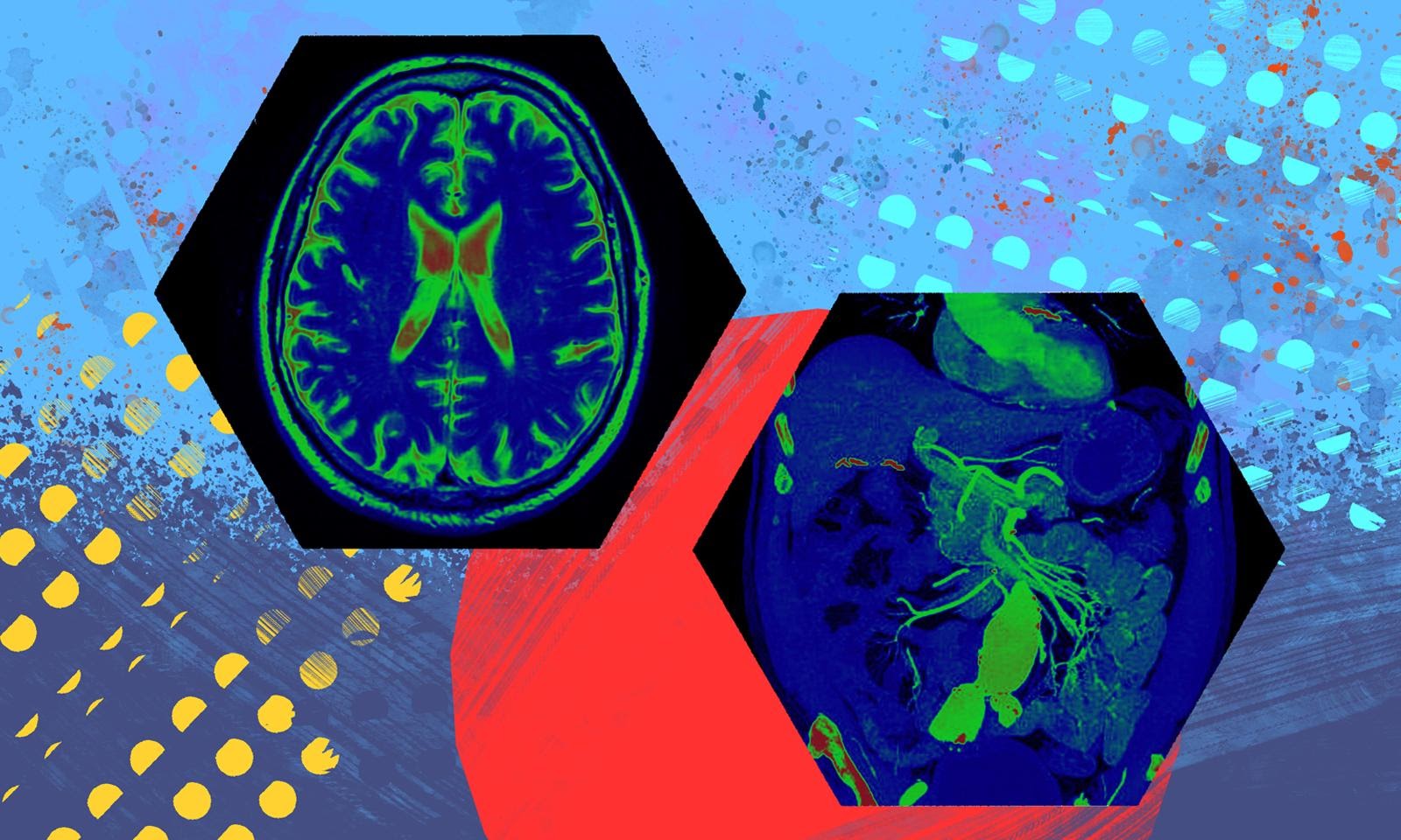 Two x-ray images of the brain on a colorful background.